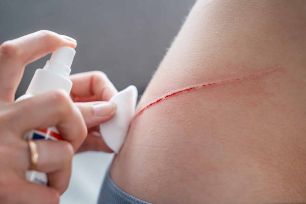 Comment bien désinfecter une plaie ou une blessure ?